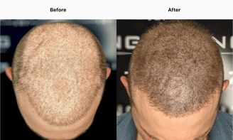 Best Scalp Micropigmentation Toronto_ATRUBARBER
