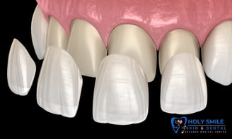 veneer treatment near kolkata