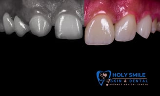 smile designing by Dr Amit Nandi at Holysmile kolkata