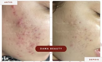 a woman with acneptictictictic and acneptictic treatment on