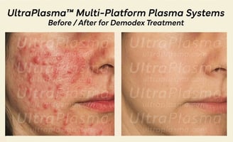 demodex_tedavi_treatment_ultra_plasma_ultra_plazma_ultra-plasma_ultra-plazma