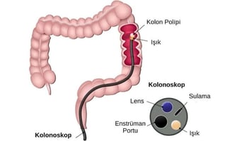 Kolonoskopi, bağırsak hastalıklarının teşhisinde kullanılan önemli bir görüntüleme yöntemidir.