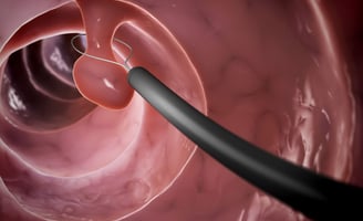 colon Polyps GASTRO FOUNDATION