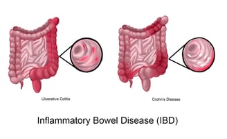 inflammatory bowel disease GASTRO FOUNDATION