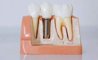 Mejores Implantes dentales en Sevilla