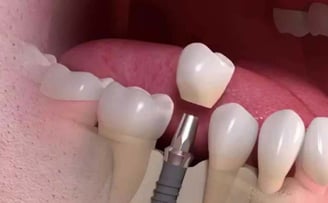 Best Dental Implants treatment in Wadgaon sheri pune