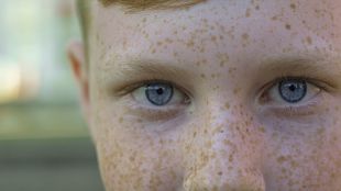 skin type prone to acne