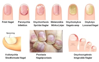 Nail Diseases