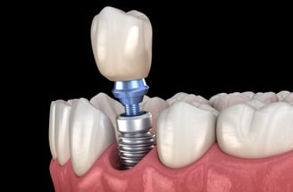 implant dentaire