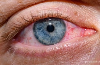 Enfermedades producidas por el polvo de uñas - Daño ocular