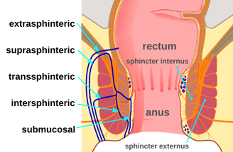 anal fistula  GASTRO FOUNDATION