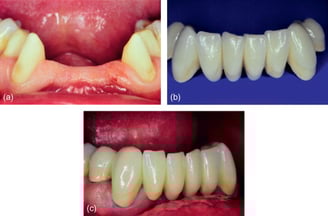 missing teeth