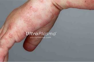 akne_acne_ultra_plasma_ultra_plazma_ultra-plasma_ultra-plazma