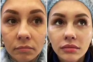 a woman with a nose job on her face and a nose