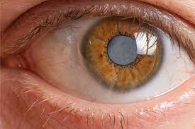 Catarata: doença dos olhos em que a visão fica opaca.