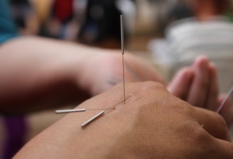 hand mit akupunkturnadeln
