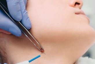 Eliminacion verrugas con tecnologia laser