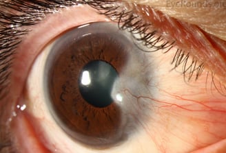foto do pterígio, carne crescida nos olhos, olho seco, cirurgia de pterigio