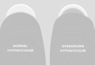 Overgrown hyponychium