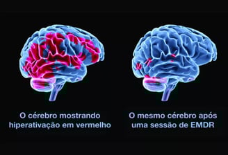Comparação tridimensional do cérebro antes e depois de EMDR, mostrando redução de hiperatividade.