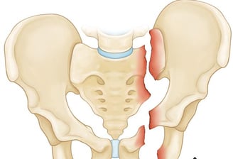Pelvic Fractures- Dr. T. Aravindh MBBS, MS( ORTHO)