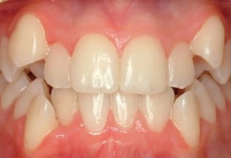 affordable tooth removal