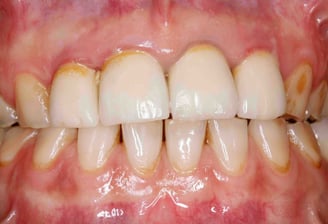 tooth cleaning in baner