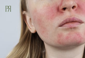 Tratamento de rosácea e doenças dermatológicas na Clínica Priori.