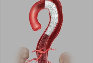 Endovascular Endoprótese