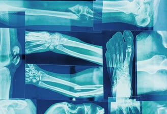 multiple overlapping blue x-rays of feet, legs, and arms
