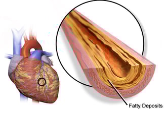 https://upload.wikimedia.org/wikipedia/commons/d/d1/Blausen_0257_CoronaryArtery_Plaque.png