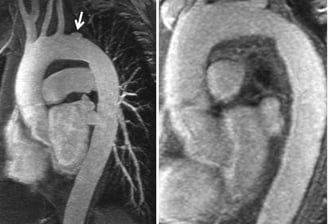 Pericardcheck aortic