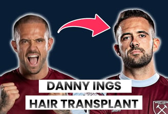 danny ings hair transplant