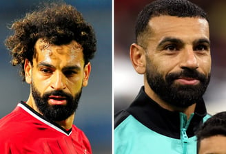 Mo salah before after hair transplant