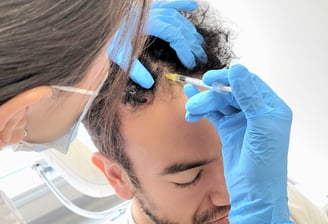 Mesoterapia capilar
