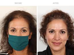 Hair transplant