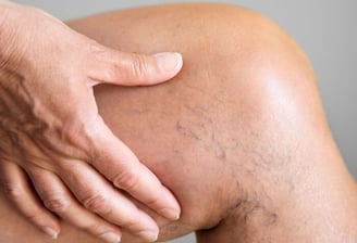varicosité des membres