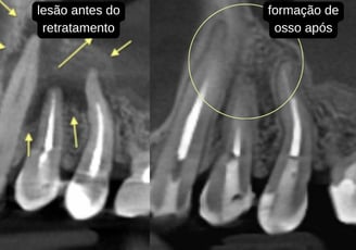radiografia antes e depois do retratamento de canal, com formação de osso