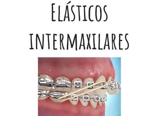 elásticos intermaxilares