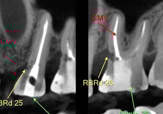 tomografia de dois dentes com reabsorções externas