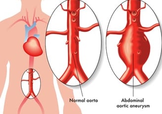 Assessment of patients with abdominal aortic aneurysm (open surgery and keyhole)