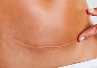 osteopatia per il trattamento delle cicatrici 
