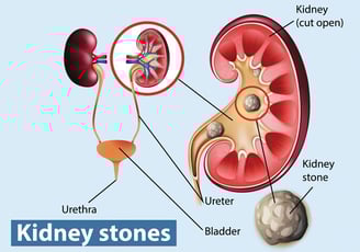 Kidney-Stones treatment near Kalaburagi, Karnataka, 