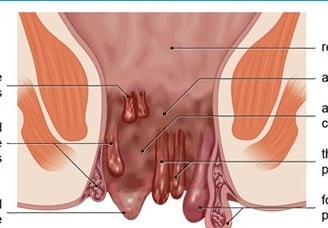 piles-hemorrhoids treatment Unani clinic near Kalaburagi, Karnataka, Dr Hidayath khan