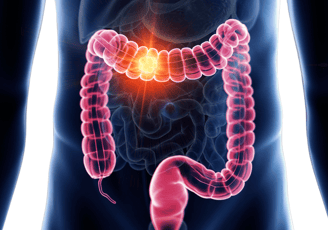 Colon cancer -Dr Maunil Tomar