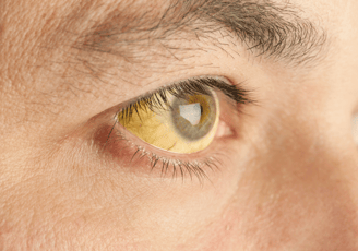 Jaundice Liver Cirrhosis