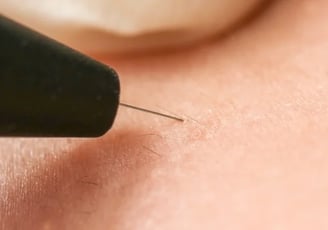 eletrólise remoção de pelos brancos