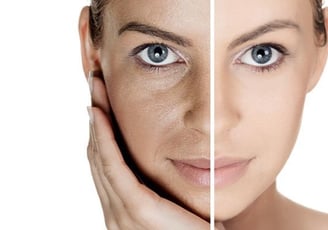 Acne treatments