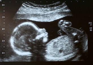 Imagem de ultrassonografia mostrando um bebê em detalhes