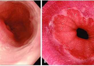 Imagem de uma Endoscopia mostrando o trato gastrointestinal